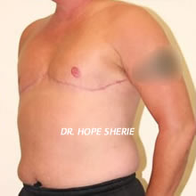 Dr. Hope Sherie - FTM Top Surgery Before and After Photos